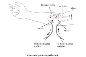 Hemodialīze: asinsvadu protēze apakšdelmā