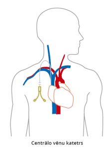 Hemodialīze: arteriovenozā
