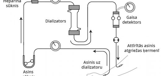Hemodialīze